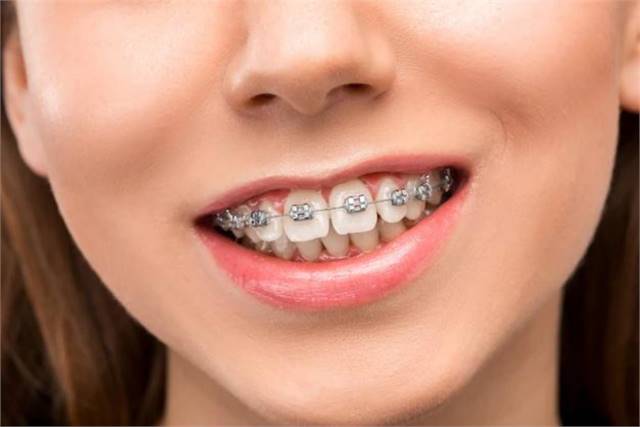 Dental Braces in Waco
