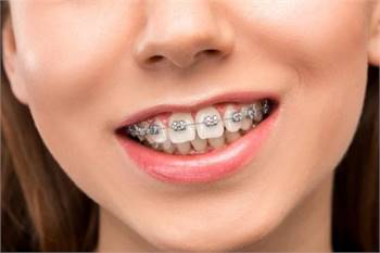 Dental Braces in Waco